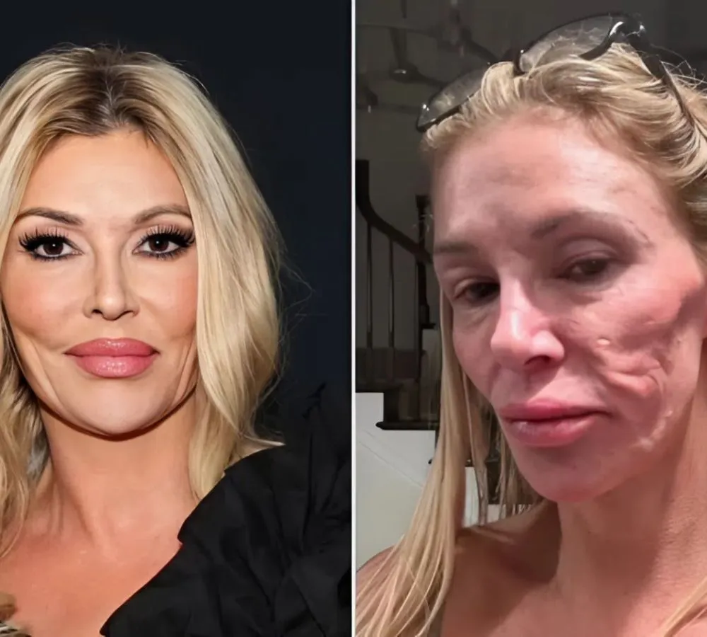 Brandi Glanville slams doctors over facial parasite crisis after spending $70K on plastic surgery consultations