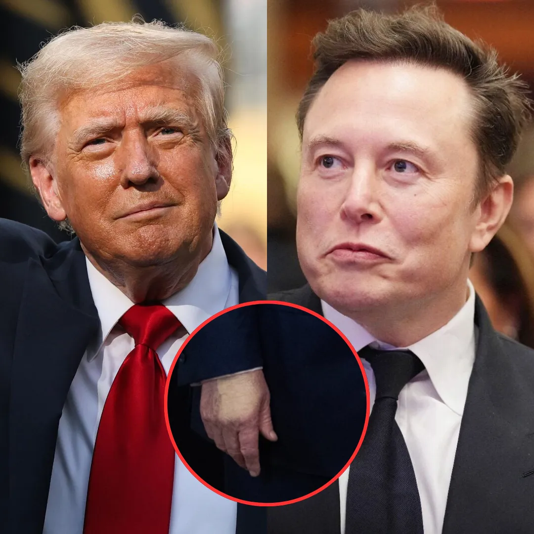 Trump Diagnosed with Chronic Venous Disease After Months of Bitter Clashes with Elon Musk