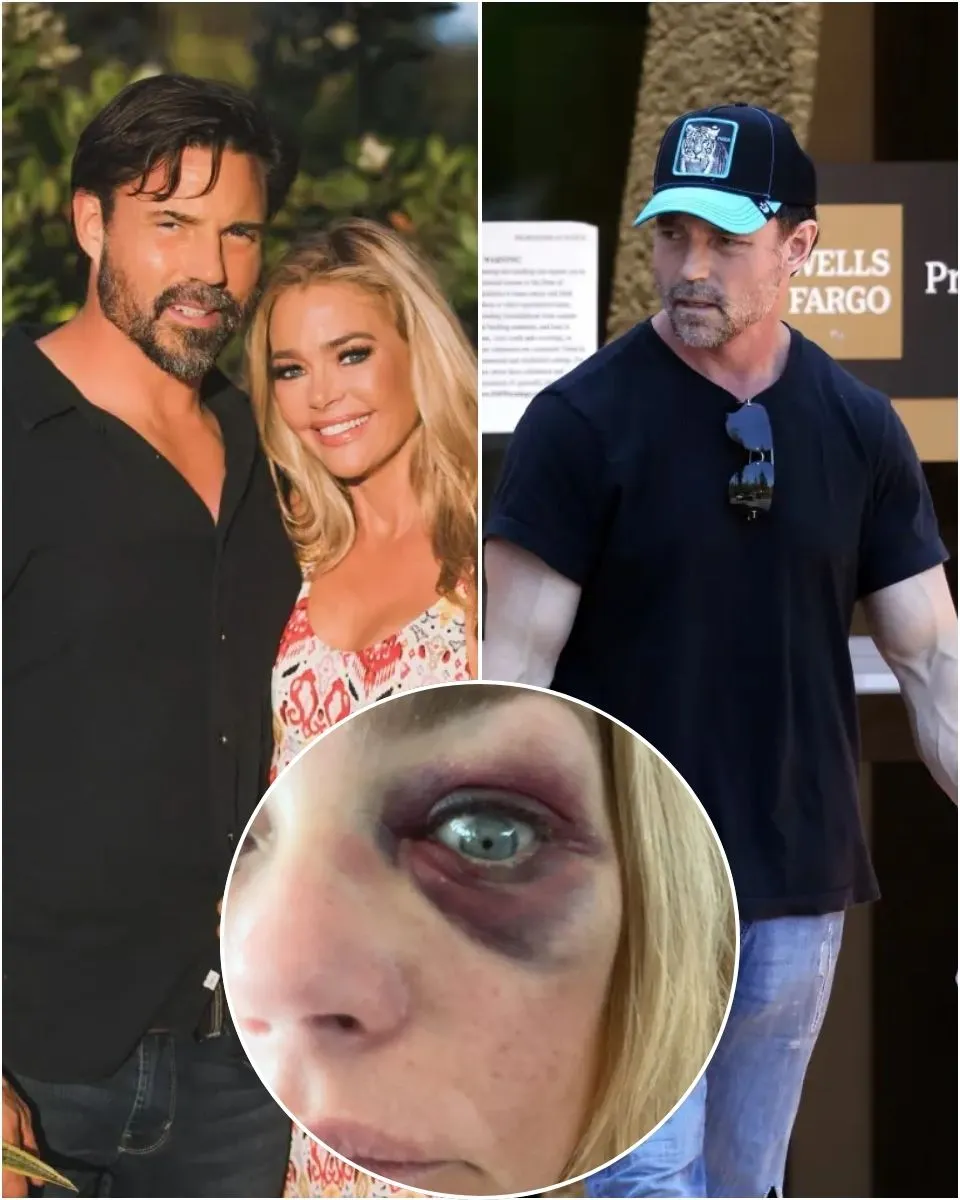 PHOTOS: Denise Richards Accuses Aaron Phypers of Horrifying Abuse and Threatening to Kill Her as RHOBH Alum Shares Pics of Her Injuries & is Granted Restraining Order