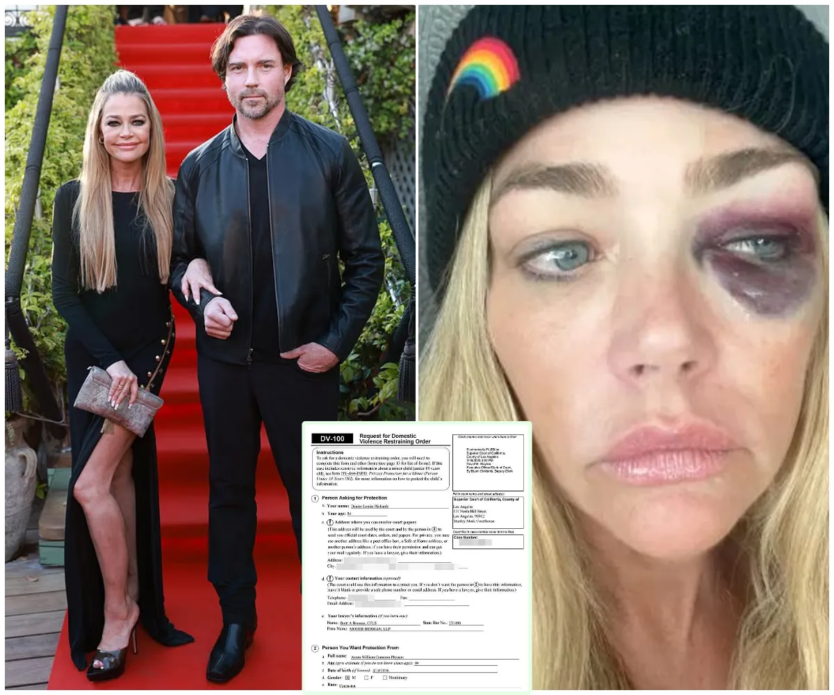 Denise Richards' estranged husband hits back with shocking claim about her black eye as explosive divorce spirals into brutal blame game of abuse allegations, restraining orders and jaw-dropping spending habits - suong