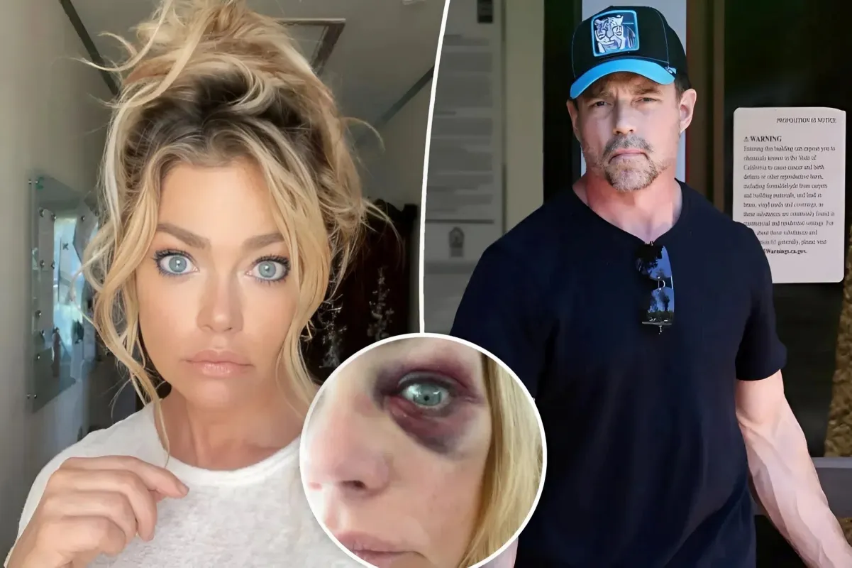 Friend of Aaron Phypers Suggests Denise Richards' Black Eye Resulted from Drunken Fall, Not Abuse - lulu