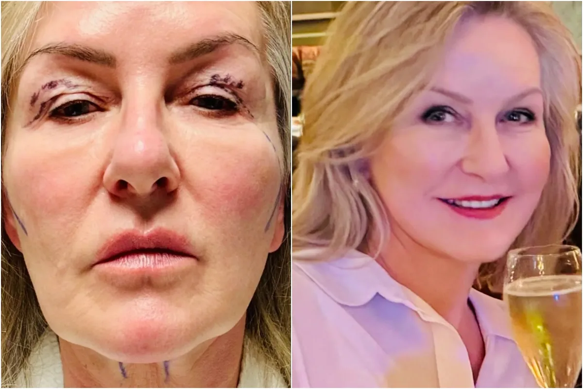 I had a 5-hour operation to fix my crinkly ‘Turkey’ neck – now I look younger and like I’ve spent a month i... ngocc