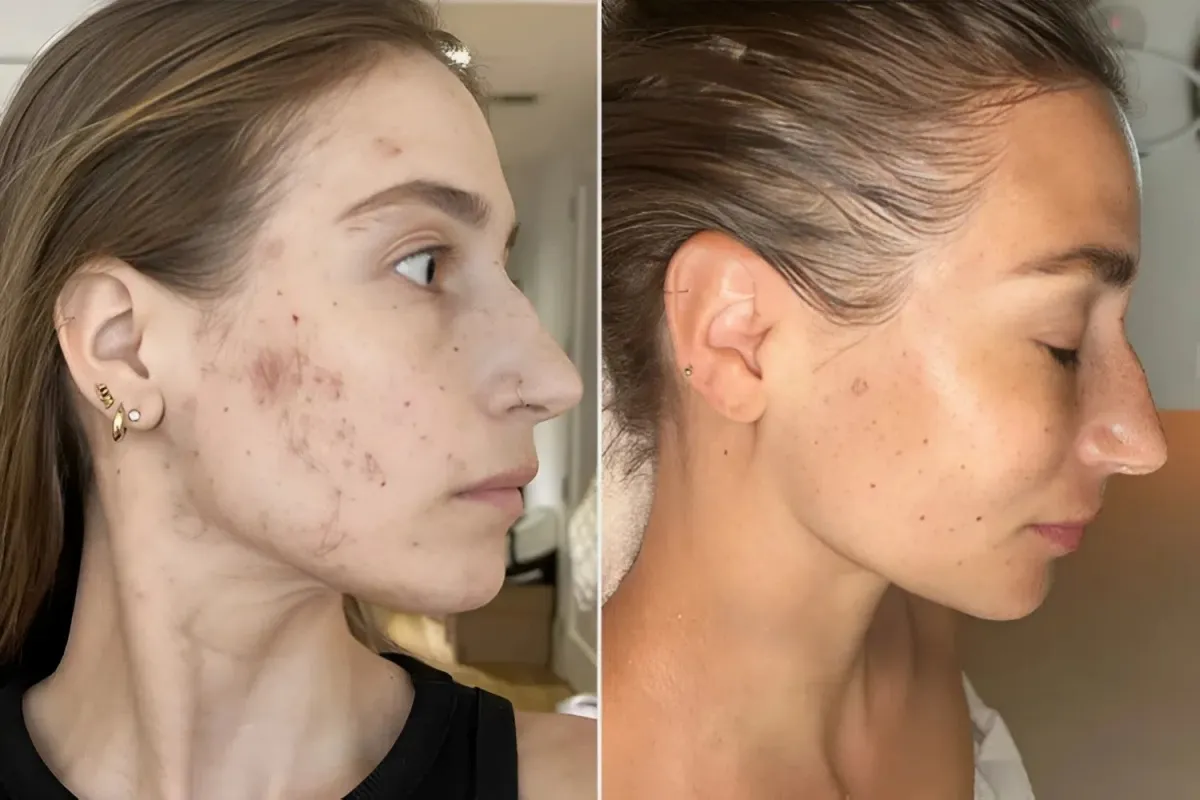 Amanda Batula on Mental Health vs. Acne: Shifting Stigma and the Invisible Struggles - lulu