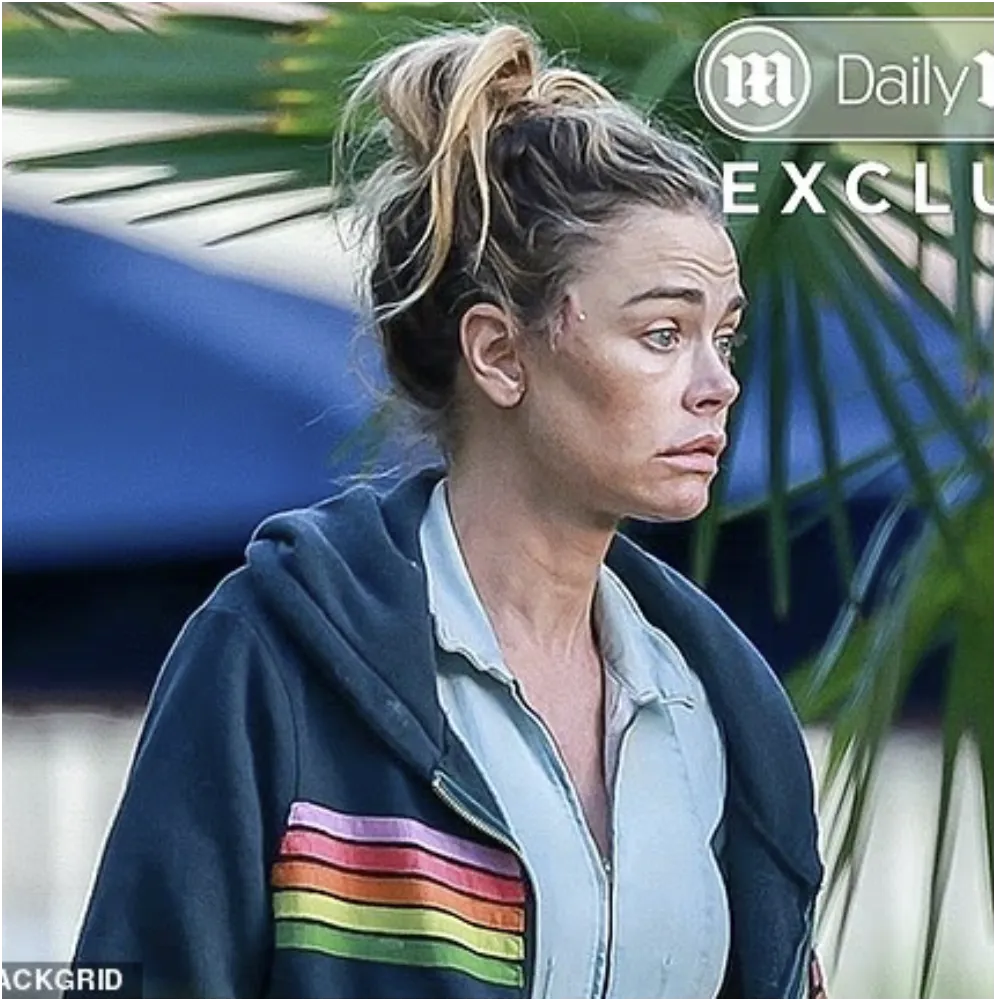 SCARRED & SHOCKING: Denise Richards Sparks Concern Over Botched Facelift Amid Explosive Abuse Allegations! SCARRED & SHOCKING: Denise Richards Sparks Concern Over Botched Facelift Amid Explosive Abuse Allegations!