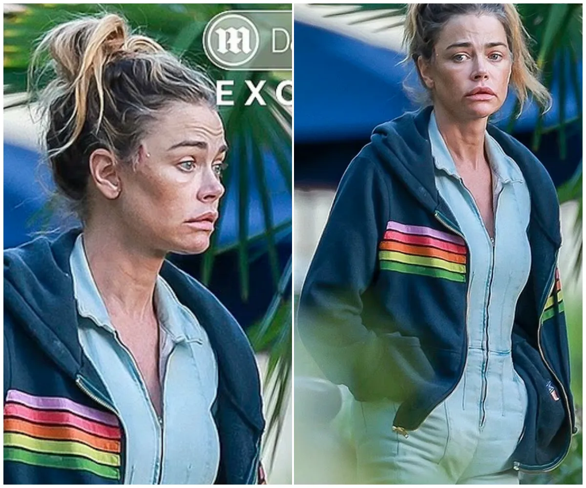 Denise Richards sparks fears over BOTCHED new 'facelift'... amid ugly divorce from Aaron Phypers - suong