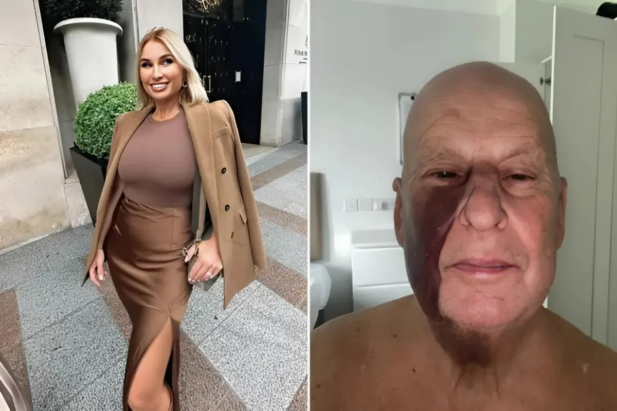 Billie Faiers’ dad reveals huge painful face bruise from battle with alcohol addiction... ngocc