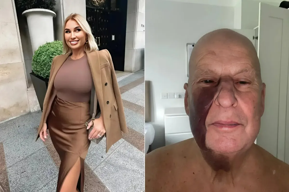 Billie Faiers’ dad reveals huge painful face bruise from battle with alcohol addiction liennhi