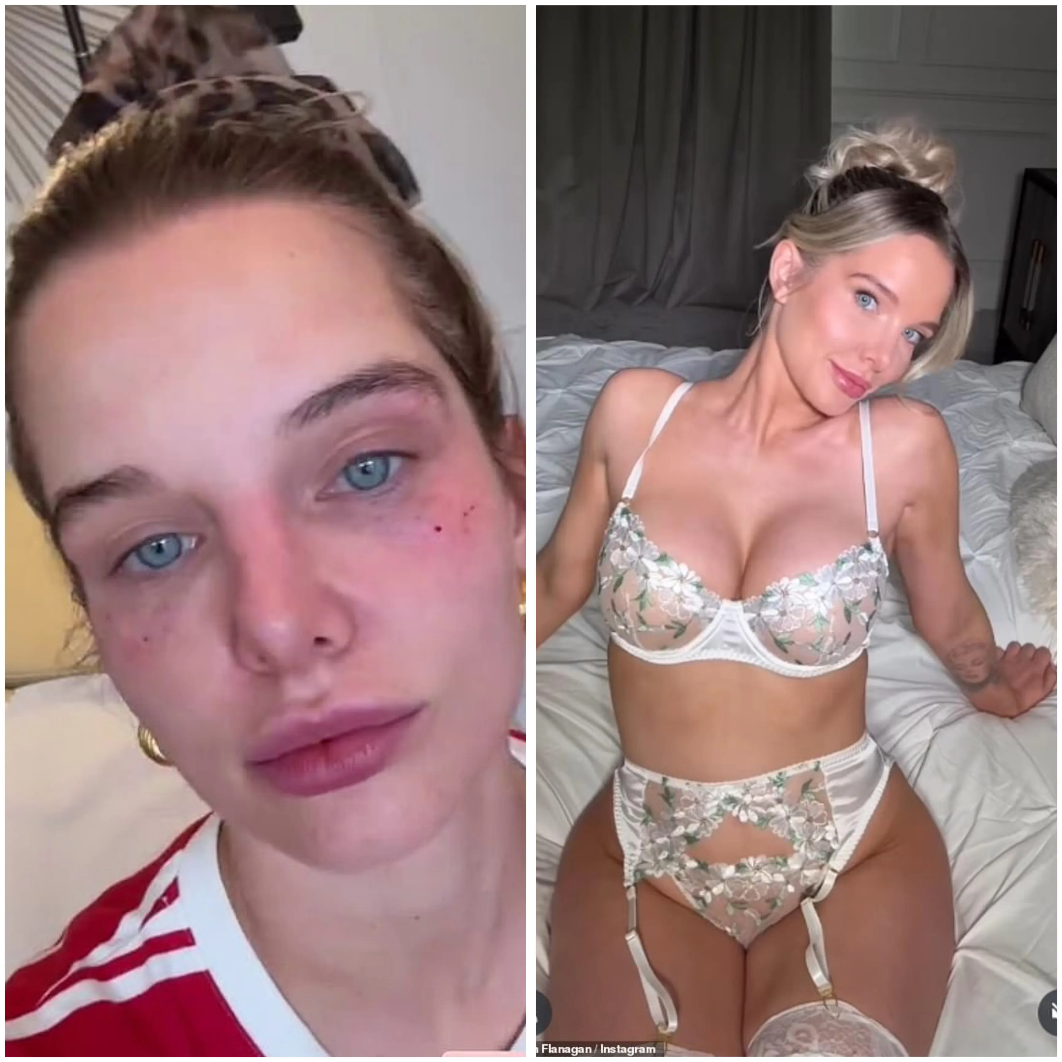 “Be worth it when I look 24” – Helen Flanagan, 34, reveals painful black eye after £400 cosmetic injections as she battles driving ban, financial strain, and chaos at home with three kids in tow - suong