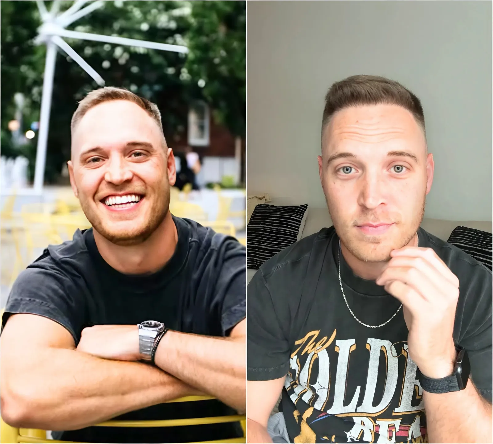 “It Was Either Fix My Hair or Fade Into Obscurity”: Jimmy Presnell Spills on the Real Cost of Fame — And the $10K Hair Transplant He Says Was ‘Non-Negotiable’ After Love Is Blind