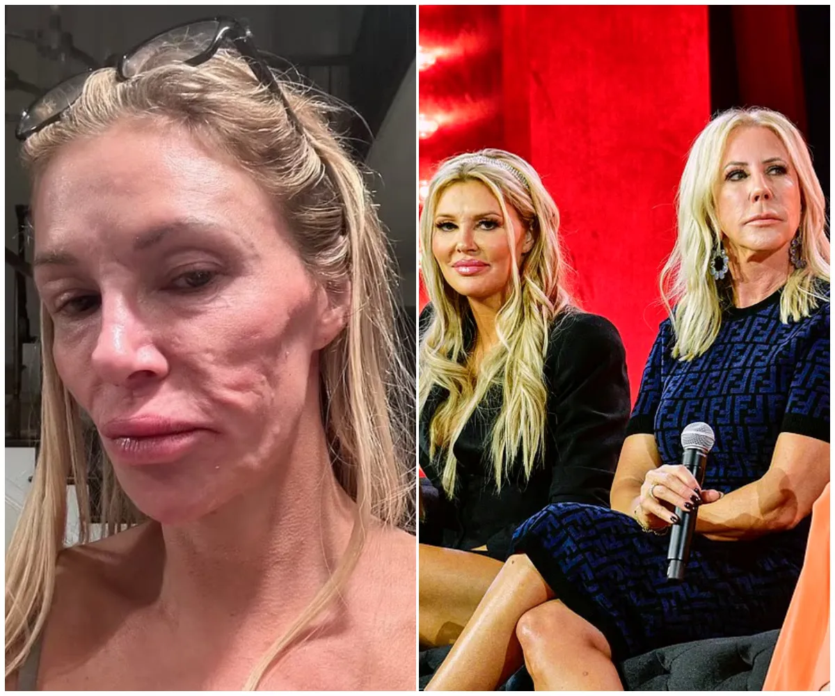 Real Housewives star claims she was infected by same parasite that disfigured Brandi Glanville - suong