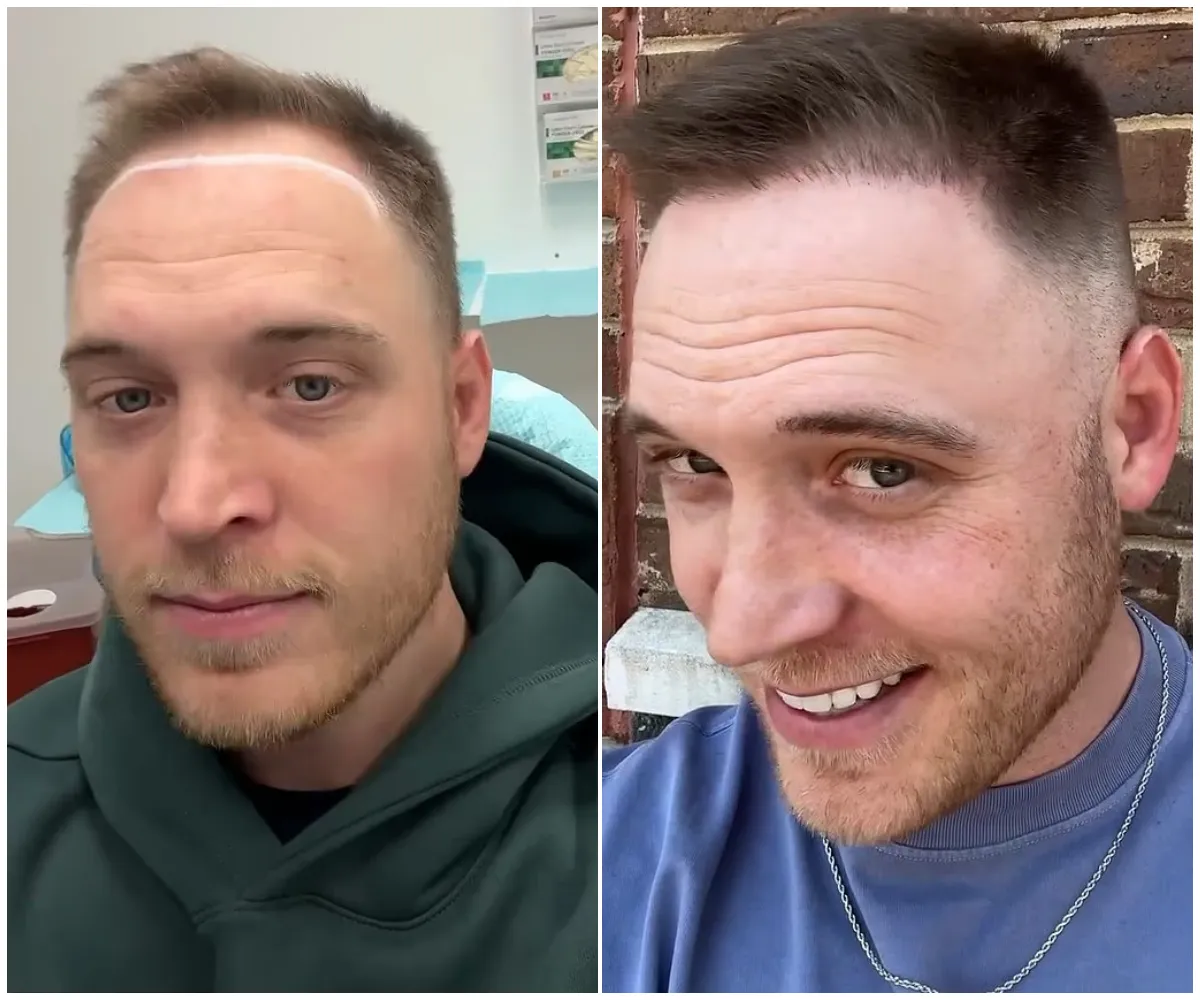 “It hurts to smile, it hurts to laugh” — Love Is Blind star Jimmy Presnell reveals secret hair transplant and shocks fans with jaw-dropping five-figure price tag, post-surgery agony, and why he refused to go to Turkey like everyone else… - suong