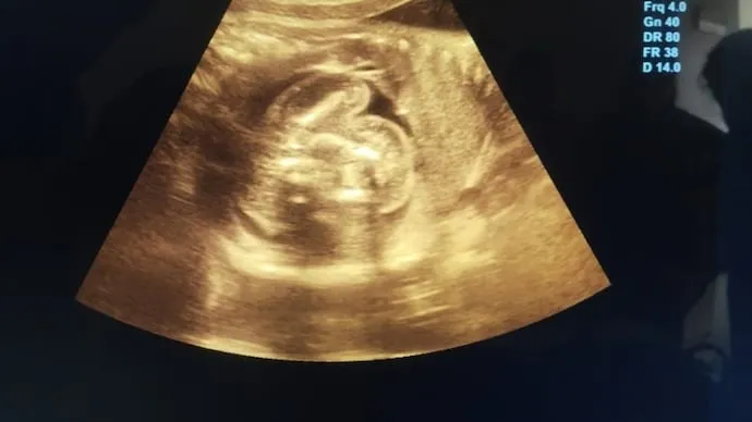 PP2. She cried with happiness, they told her she was pregnant with triplets, but the… See more