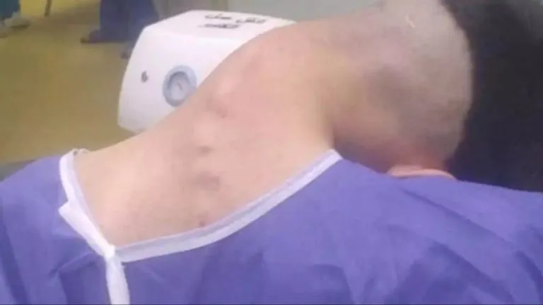 PP1. Young man hospitalized because he dropped his ca...See more