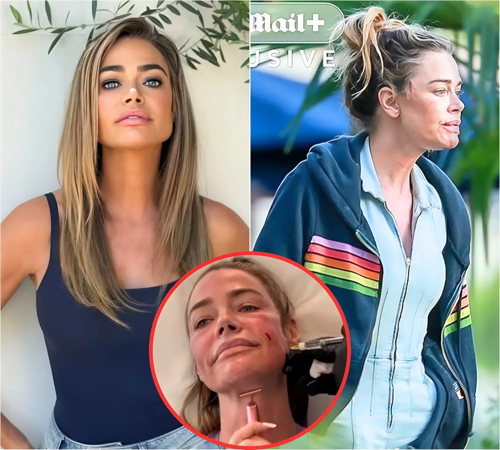 RHOBH’s Denise Richards Sparks Facelift Rumors as She’s Seen With Suspicious Scars on Face, Plus Plastic Surgeon Weighs in RHOBH’s Denise Richards Sparks Facelift Rumors as She’s Seen With Suspicious Scars on Face, Plus Plastic Surgeon Weighs in