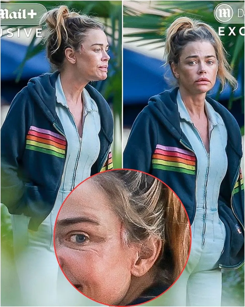 PHOTOS: RHOBH’s Denise Richards Sparks Facelift Rumors as She’s Seen With Suspicious Scars on Face, Plus Plastic Surgeon Weighs in