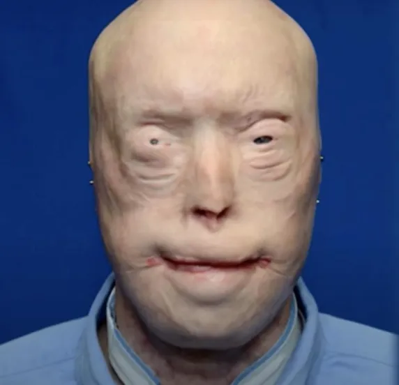 Firefighter Has Face Transplant After Third-Degree Burns And Survives Against All Odds – See Him Now, 7 Years Later