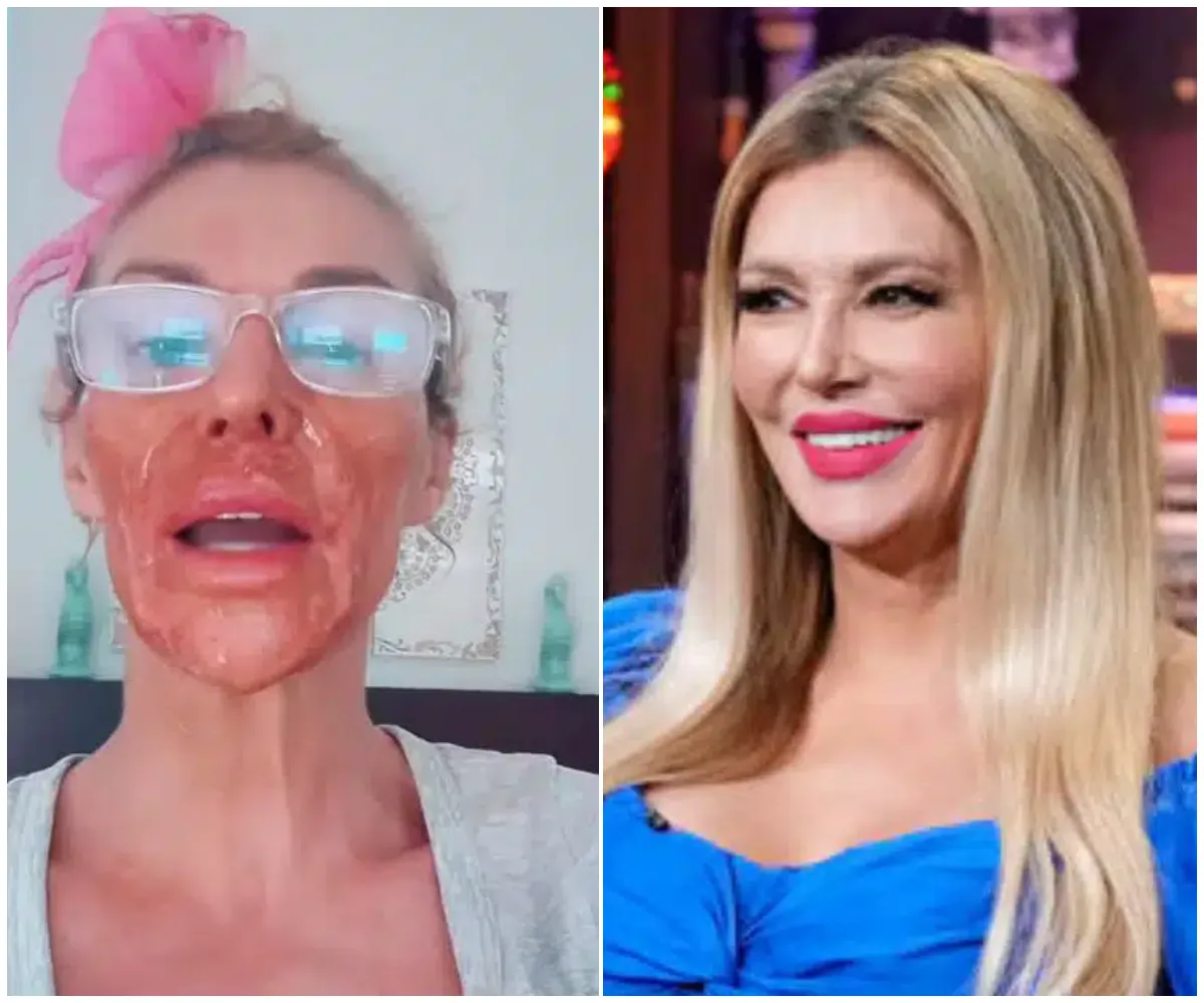 Brandi Glanville Uses Nair (Hair Removal Cream) As An Exfoliant – Her Facial Parasite Flees From The Chemical - suong