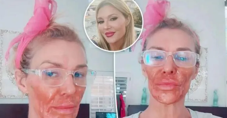 Brandi Glanville severely burns face in attempt to kill facial parasite