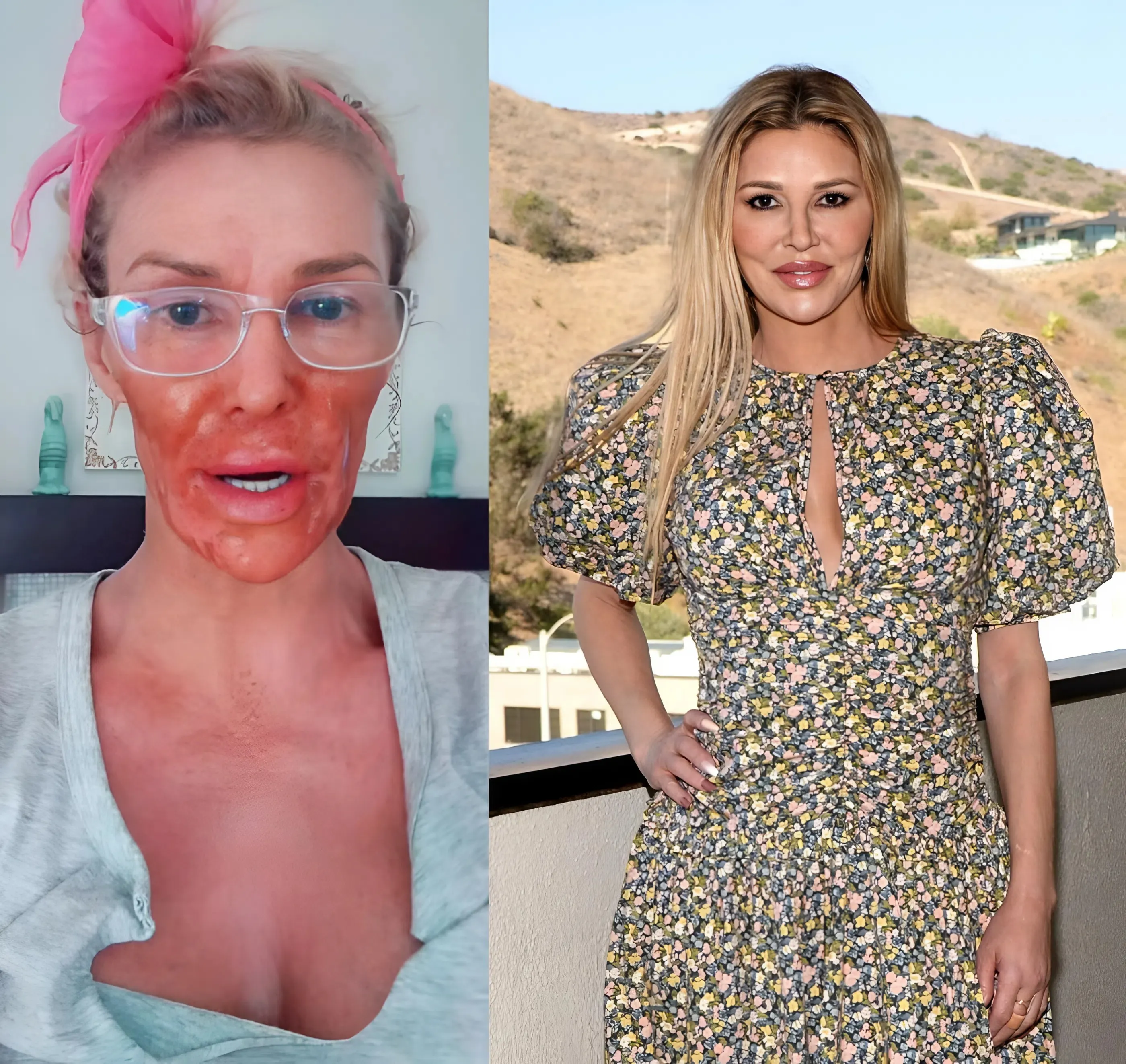 "SHOCKING VIDEO: Brandi Glanville Burns Face to Nair While Confronting 'Parasite Caroline' in Disturbing TikTok Video!"