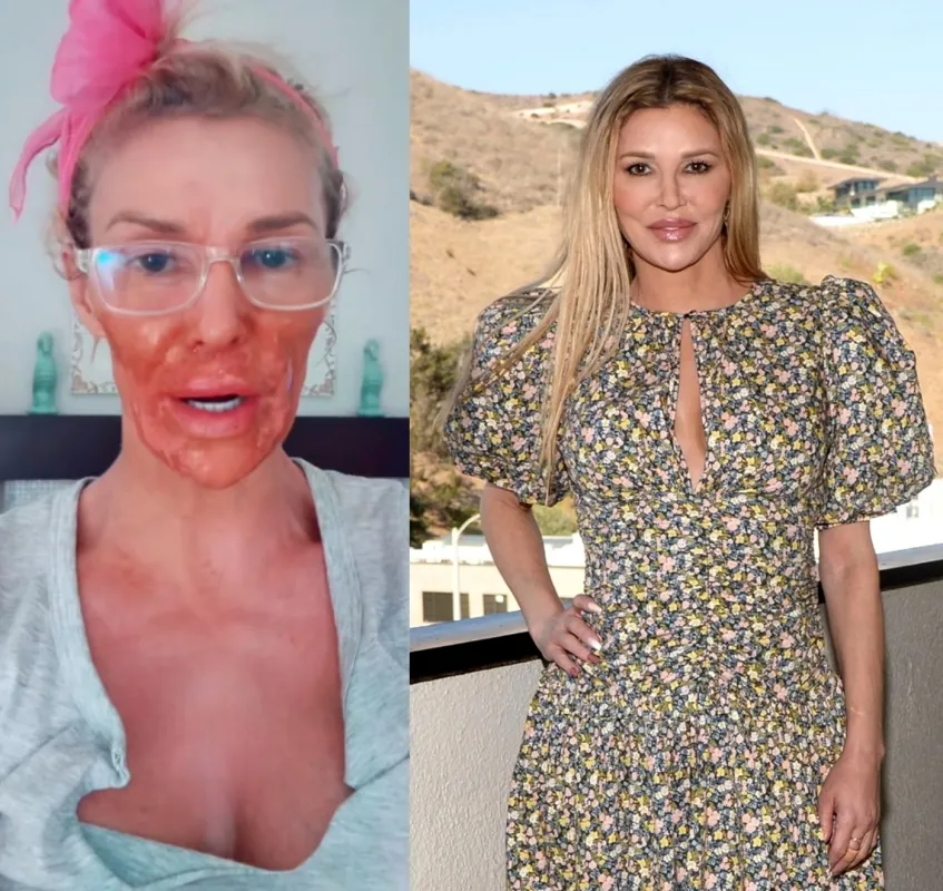 VIDEO: Brandi Glanville Burns Face With Nair Amid Battle With Facial Parasite ‘Caroline’ in Bizarre TikTok
