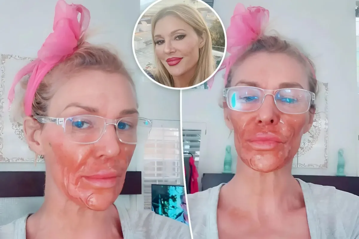 Brandi Glanville's Shocking Mishap: Severe Facial Burn While Battling a Facial Parasite - lulu