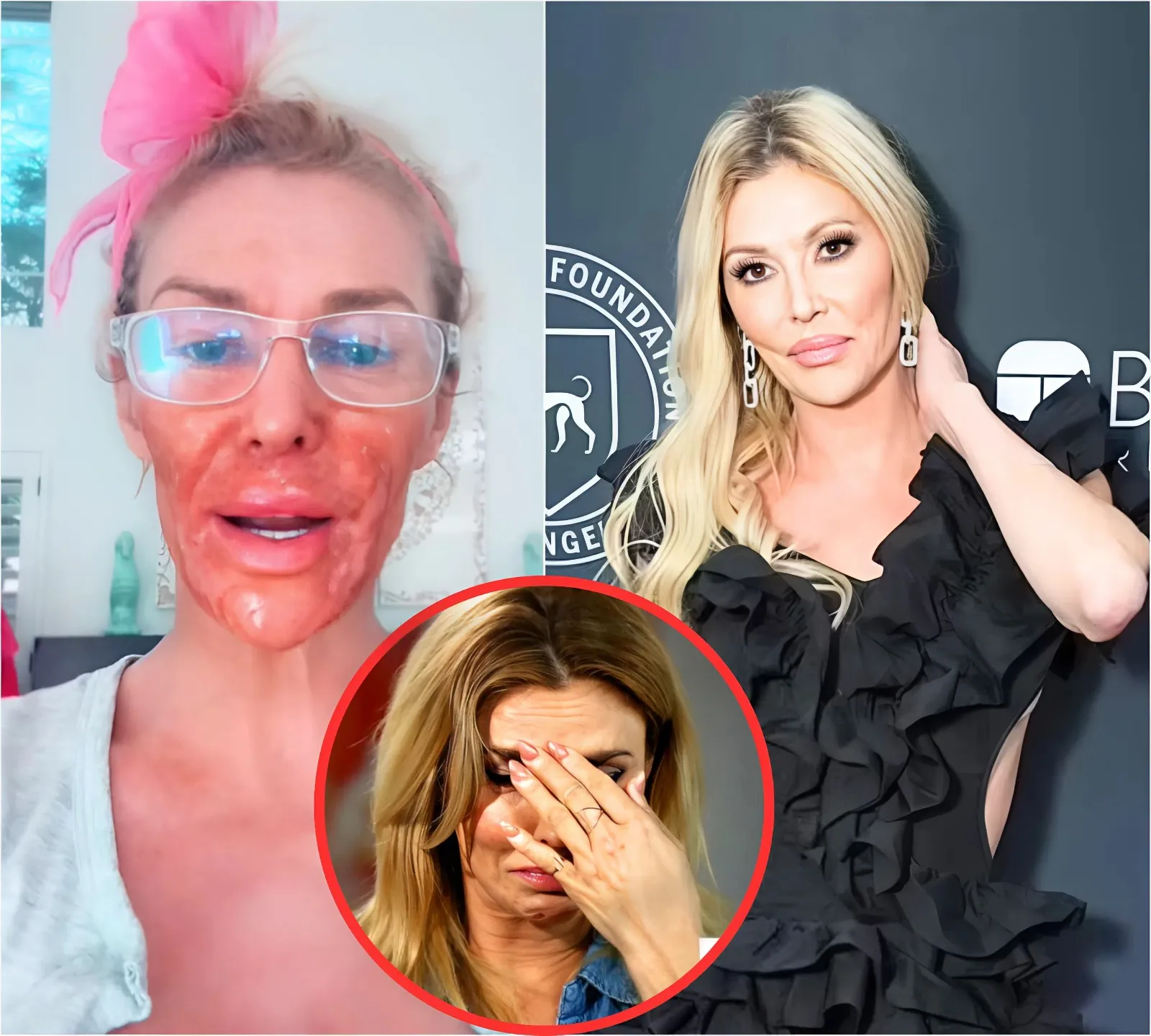 Brandi Glanville Burns Face With Nair Amid Battle With Facial Parasite ‘Caroline’ in Bizarre TikTok