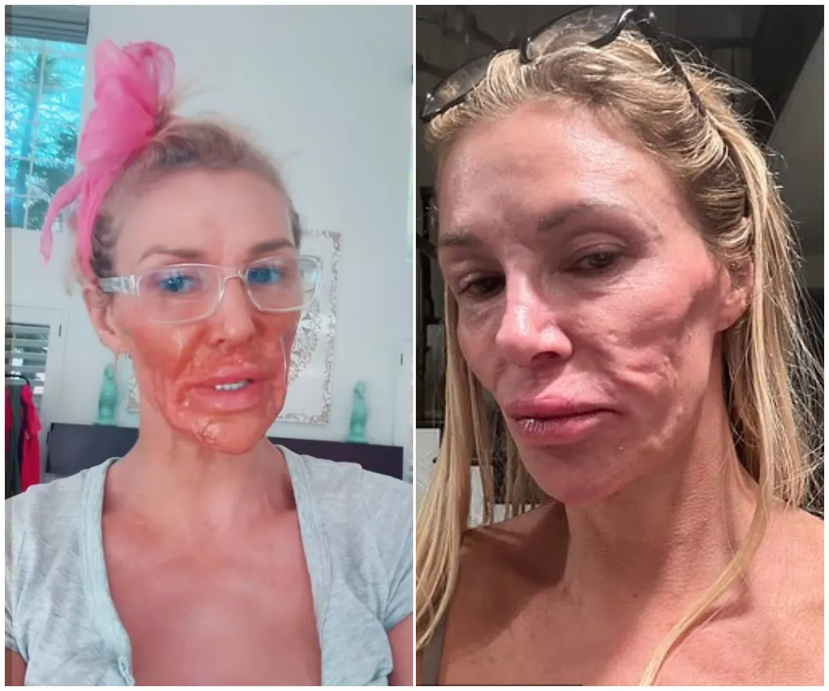 Brandi Glanville risks BLINDING herself as she BURNS face with chemical hair‑removal cream in shocking DIY bid to ‘cure’ mystery facial parasite — just months after spending $113K on failed treatments - suong