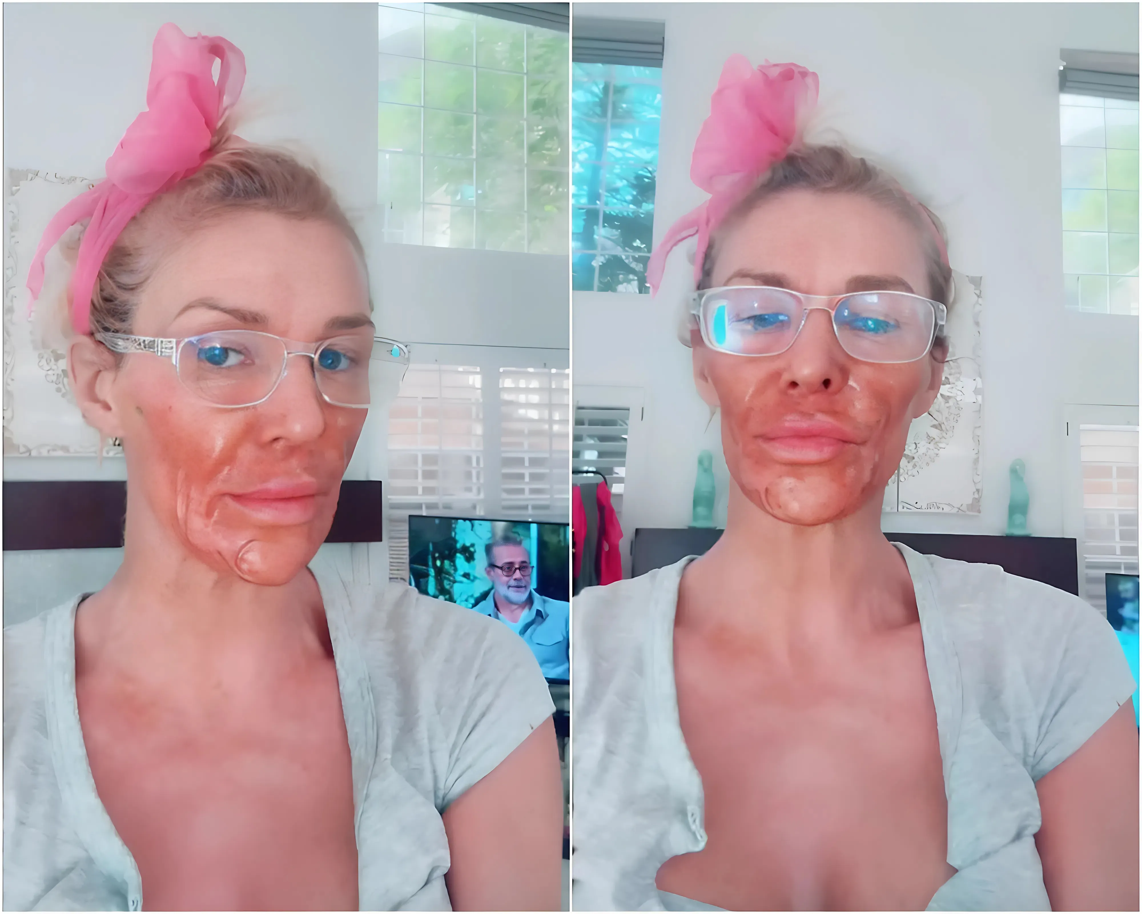 Brandi Glanville severely burns face in attempt to kill facial parasite