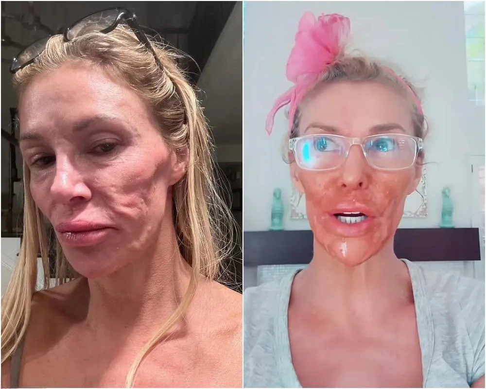 Brandi Glanville names her facial parasite after her ‘Real Housewives’ nemesis