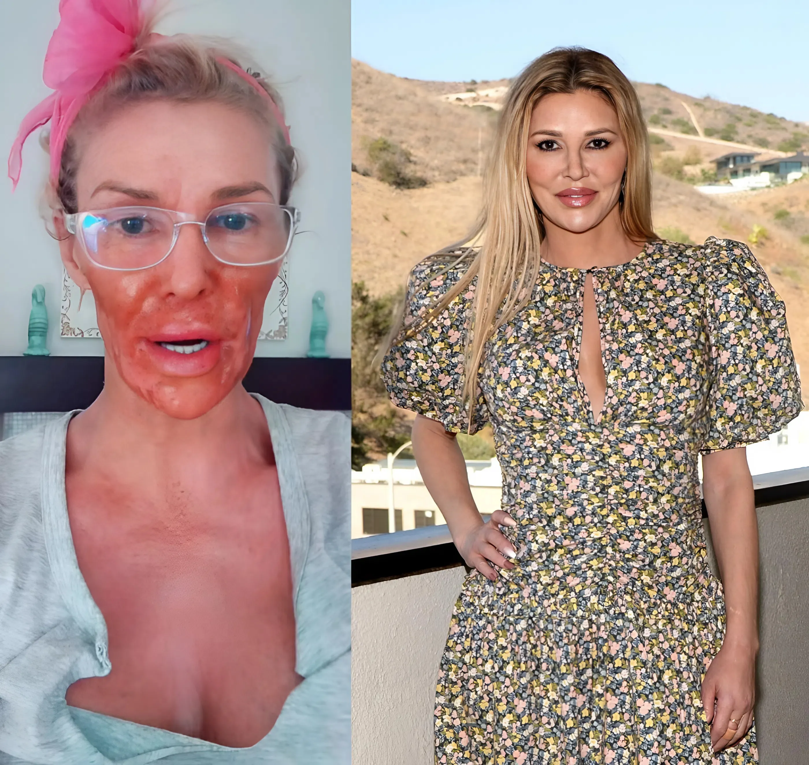 VIDEO: Brandi Glanville Burns Face With Nair Amid Battle With Facial Parasite ‘Caroline’ in Bizarre TikTok