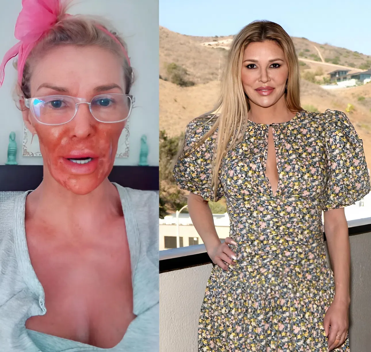 VIDEO: Brandi Glanville Burns Face With Nair Amid Battle With Facial Parasite ‘Caroline’ in Bizarre TikTok