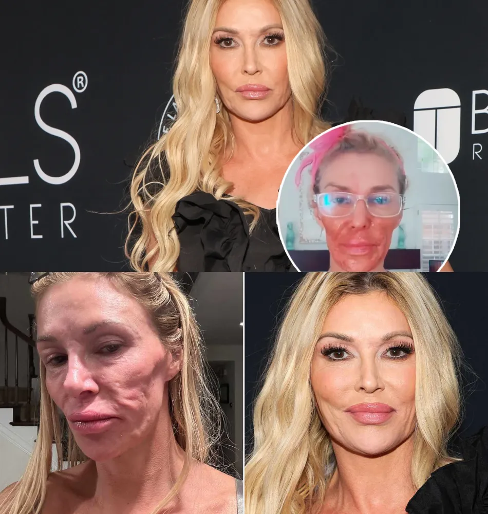 VIDEO: Brandi Glanville Burns Face With Nair Amid Battle With Facial Parasite ‘Caroline’ in Bizarre TikTok