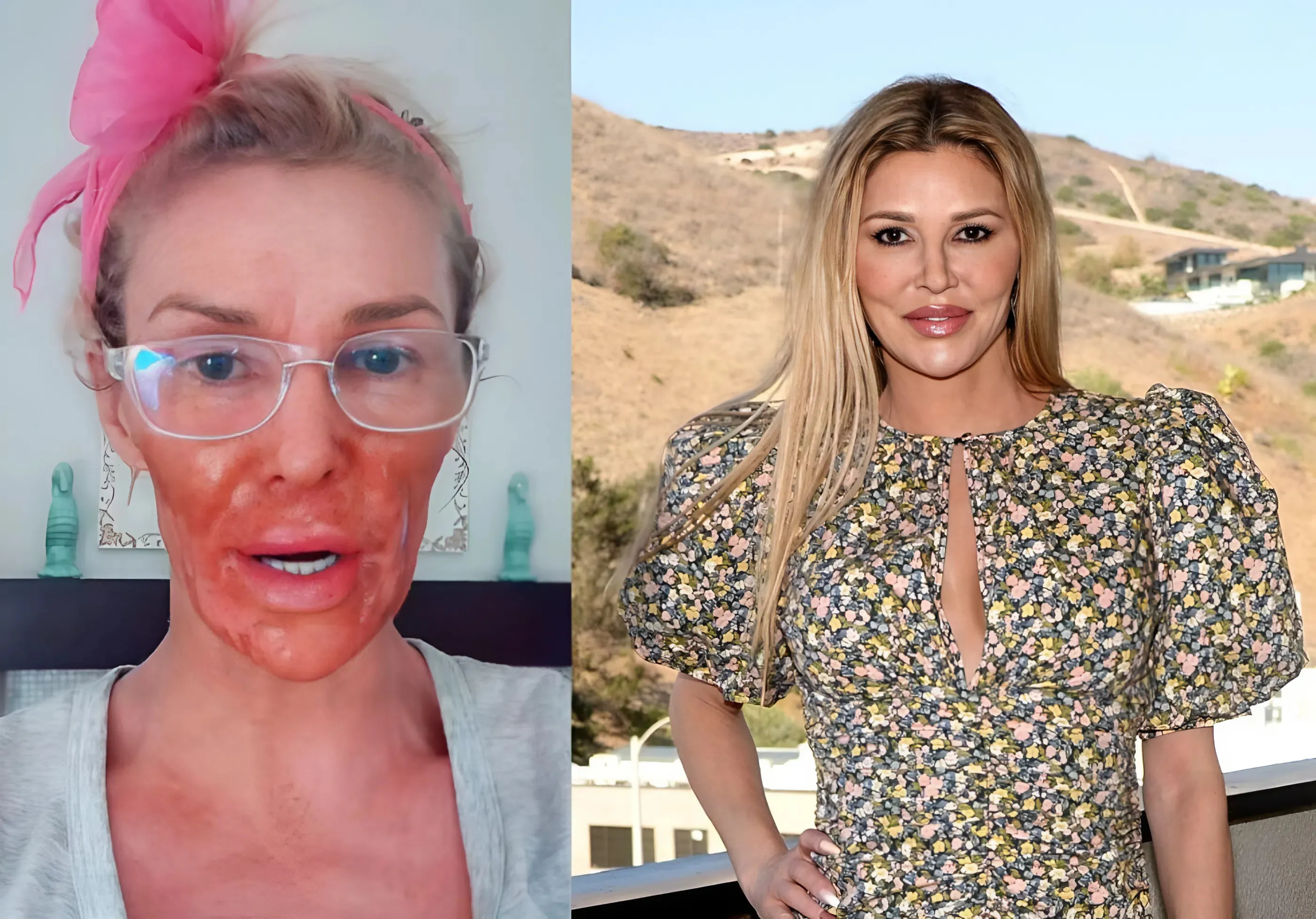 Brandi Glanville Burns Face With Nair Amid Battle With Facial Parasite ‘Caroline’ in Bizarre TikTok