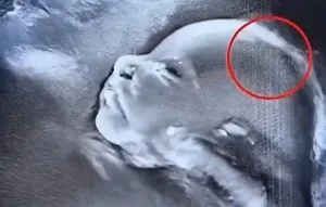 PP4.  Doctors couldn’t believe what they saw during the ultrasound