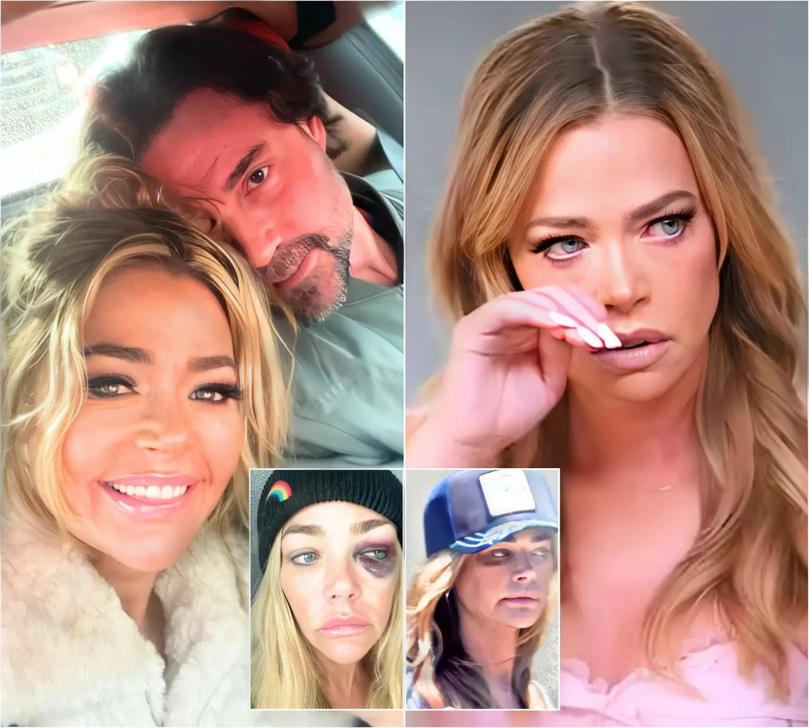 Denise Richards is Pictured With a “Black Eye” After Police Encounter at Aaron Phypers’ Home, Find Out What an Insider is Saying