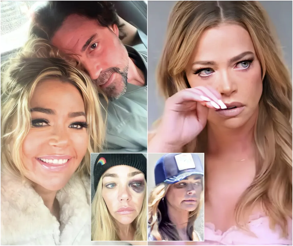 DENISE RICHARDS SPOTTED WITH A “BLACK EYE” AFTER POLICE ENCOUNTER AT AARON PHYPERS’ HOME!