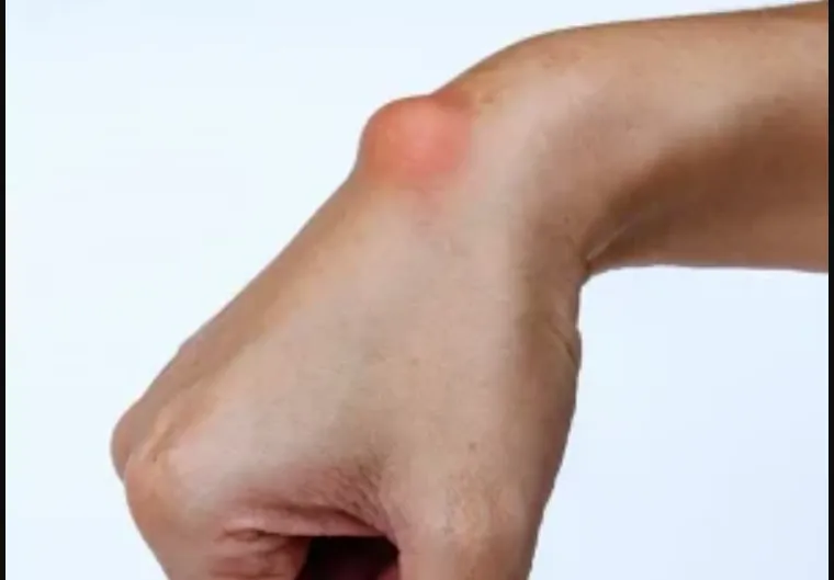 PP1.  This Lump may Appear Due to Something you do Every day