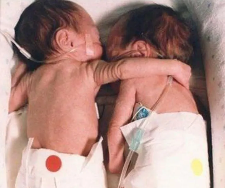 Mom could hardly wait to give birth – When the TWINS were born, she was informed that one of them was dying!