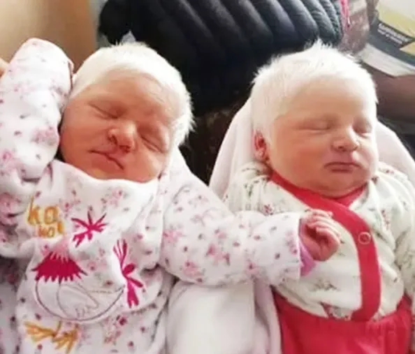 The First Ever Albino Twins Born In Argentina Will Leave You In Awe