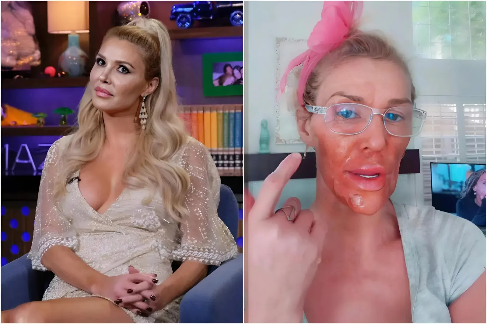 ‘RHOBH’ Star Brandi Glanville Shocks Fans with Burned Face After DIY Chemical Peel