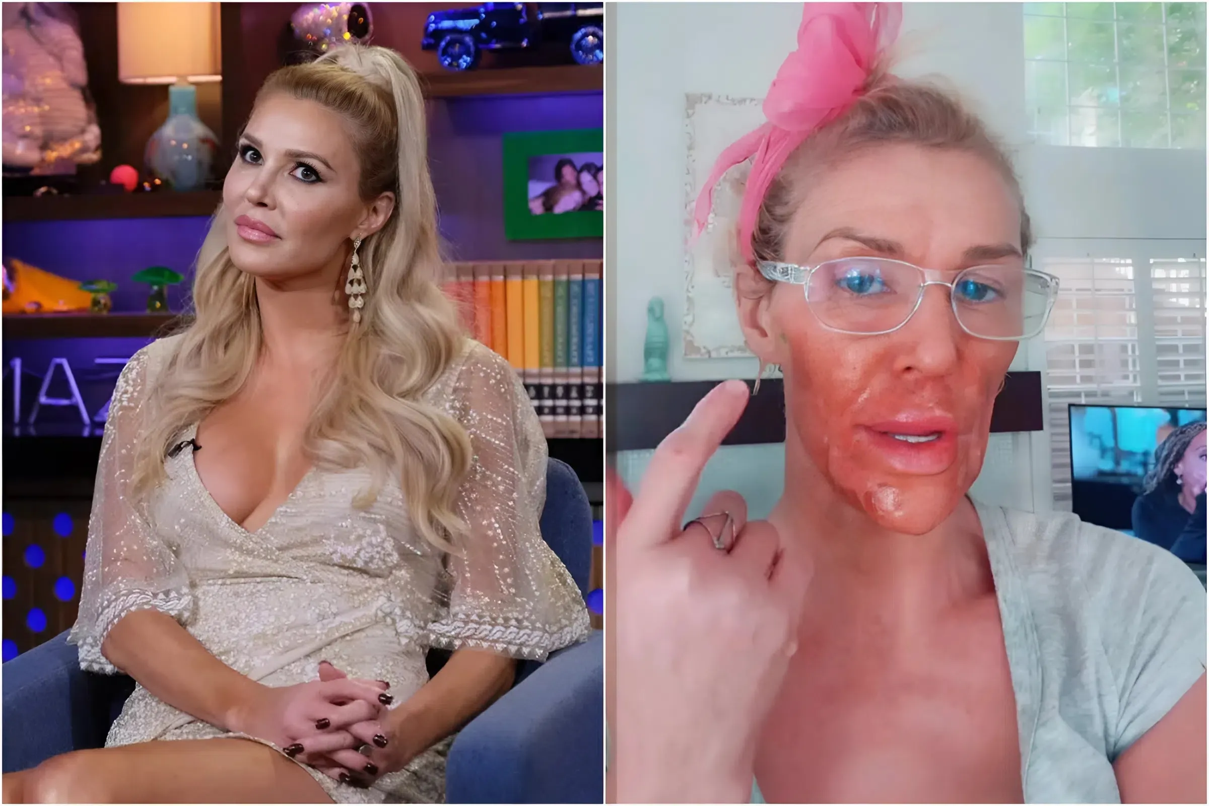 ‘RHOBH’ Star Brandi Glanville Shocks Fans with Burned Face After DIY Chemical Peel trucc