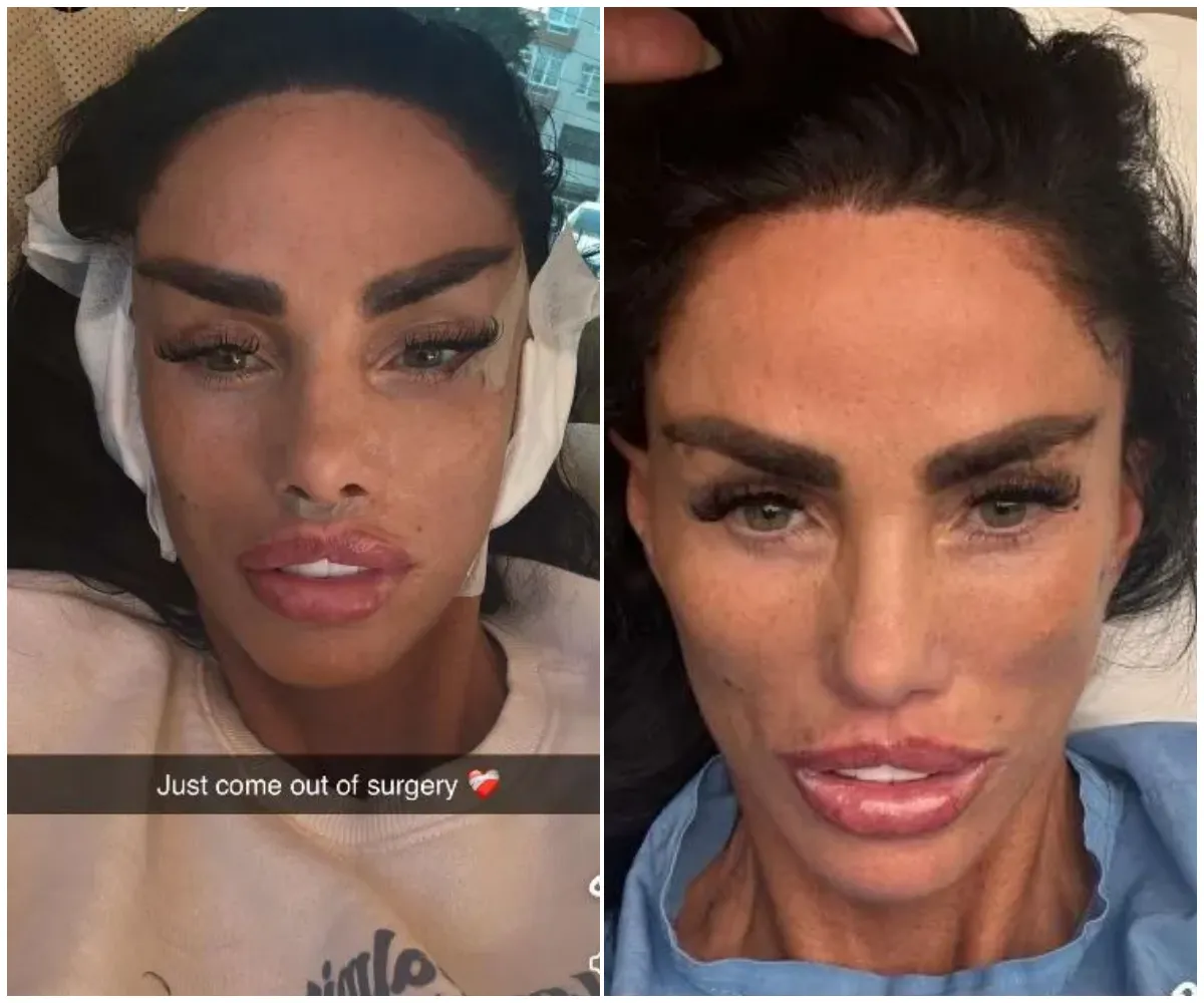 ‘Just come out of surgery’ — Katie Price reveals shockingly puffy face in raw before-and-after pics after yet ANOTHER op in Turkey… as she escapes to clinic amid explosive rift with daughter Princess - suong