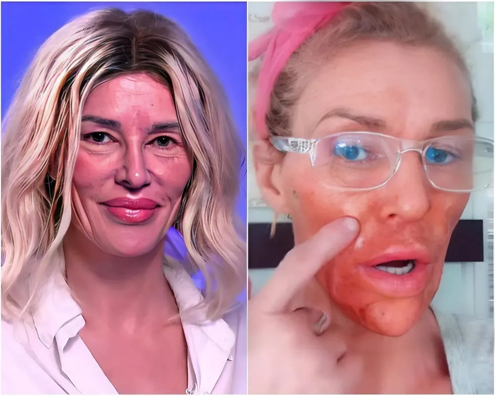 Brandi Glanville Face Parasite: She's Spent Over $100K on 21 Doctors to Find Fix - lulu