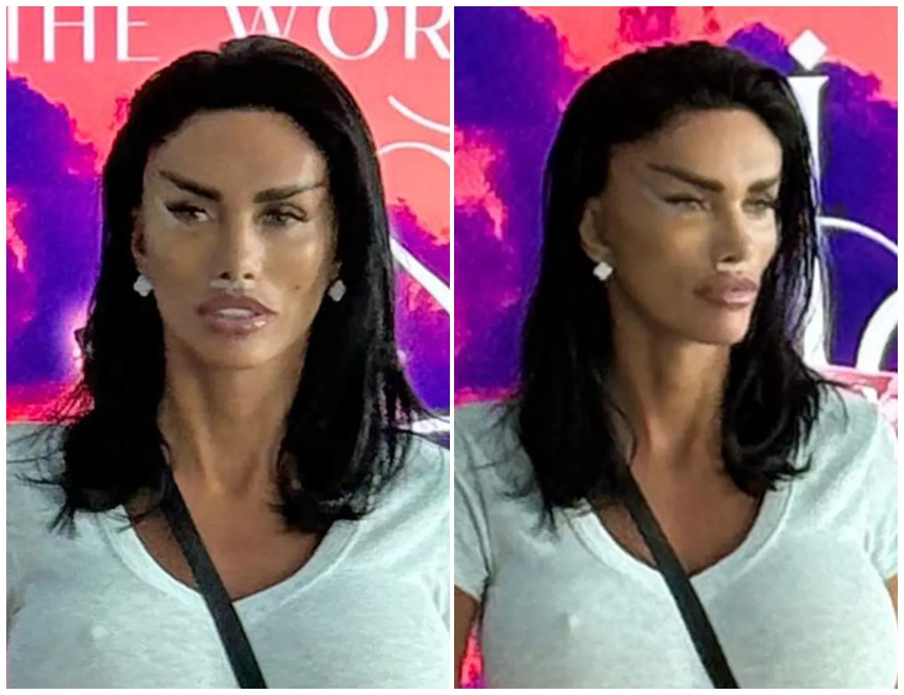 Katie Price unveils strikingly tight post-surgery look at Istanbul airport after undergoing dramatic ‘fox eye’ facelift in Turkey — emerging with surgical tape still on her face, fresh scars and a noticeably... - suong