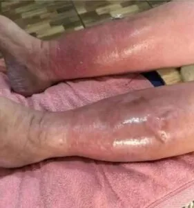 HT10. Health Warning Signs on Your Feet You Should Never Ignore