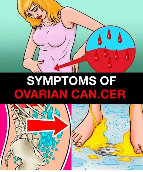 Symptoms of Ovarian Can.cer… See more in 1st comment