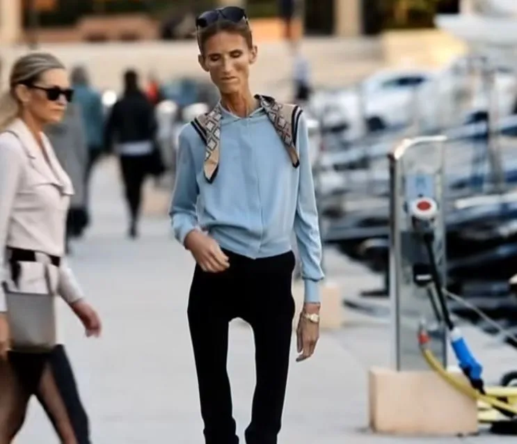 Battle against anorexia! The way the girl looked before anorexia left everyone speechless